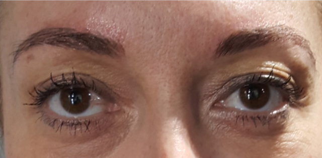 Microblading at the Clinique Anti Aging of Montreal