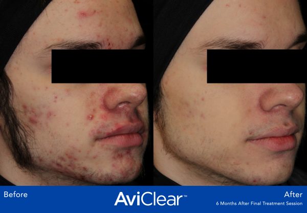 05_AviClear_BA_2-photos-600x416