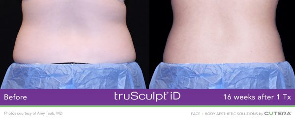 truSculpt-iD-Amy-Taub-MD-1-600x245
