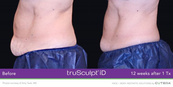 truSculpt-iD-Amy-Taub-MD-2-600x301