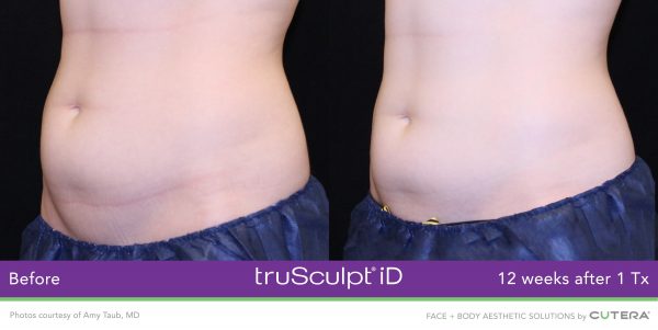 truSculpt-iD-Amy-Taub-MD-3-600x301