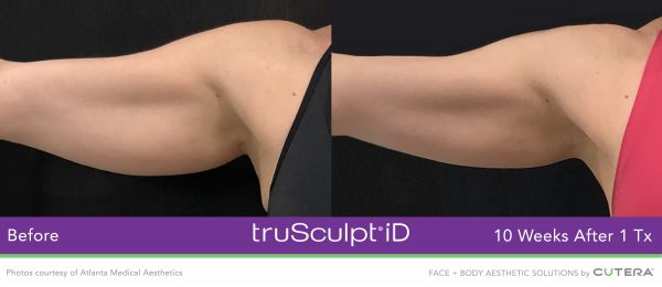 truSculpt-iD-Atlanta-Medical-Aesthetics-600x260