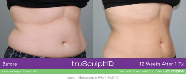truSculpt-iD-B-A-T-Desai-A-600x266